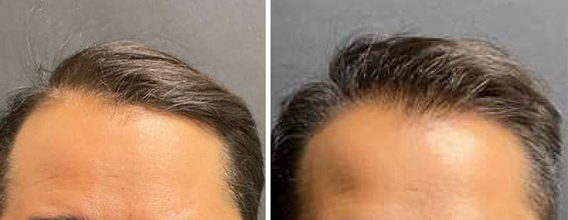 NeoGraft Before & After Image