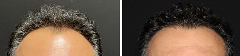 NeoGraft Before & After Image